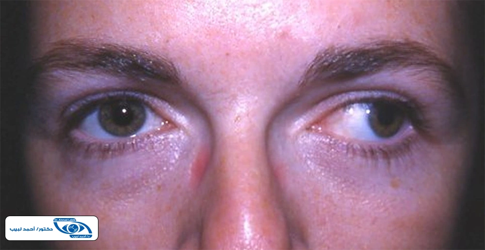 علاج انحراف العين الشديد