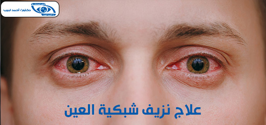 علاج نزيف شبكية العين بالليزر