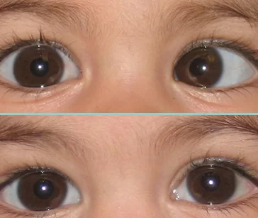 عملية تصحيح انحراف العين للاطفال