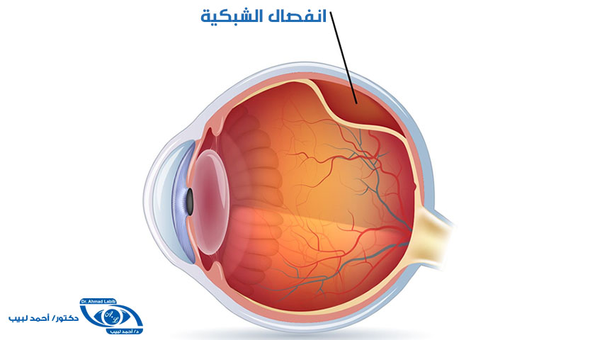انفصال الشبكية retinal detachment